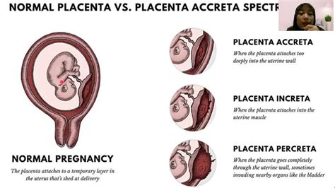 RETENSIO PLASENTA DAN MANUAL PLASENTA - YouTube