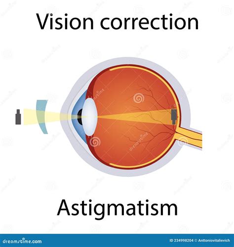 Vision Correction of Astigmatism Illustration. Eyesight Disorders. Eyes ...