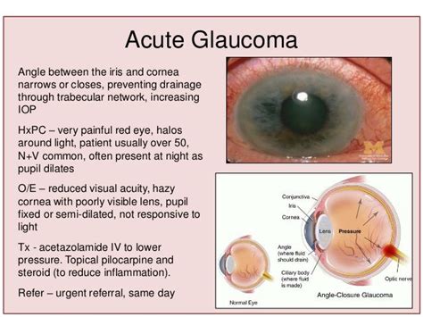 Acute Angle Glaucoma Symptoms