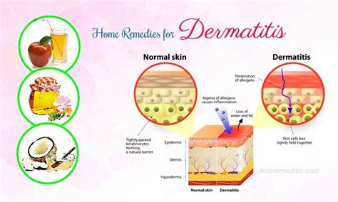 23 Natural Home Remedies For Dermatitis Symptom Relief