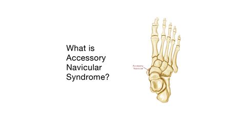 Accessory Navicular Syndrome: Symptoms & Treatment | Visalia Podiatrist