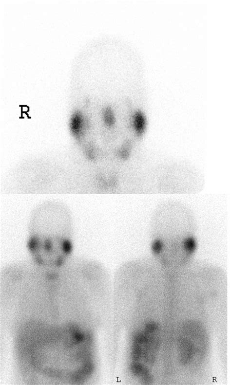 A Gallium scan showing increased uptake in the parotid glands, salivary... | Download Scientific ...