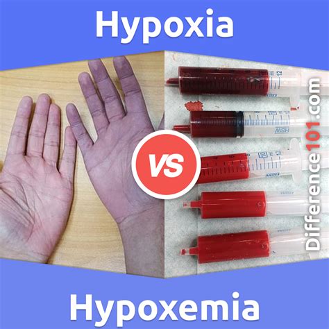 Hypoxia vs. Hypoxemia: 5 Key Differences, Pros & Cons, Similarities ...