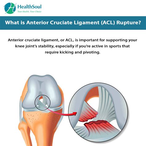 Anterior Cruciate Ligament