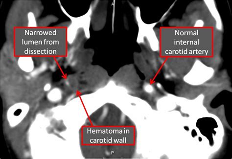 Carotid Dissection Causes, Diagnosis and Treatment