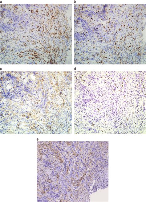 Immunohistochemical profiles of the tumor-infiltrating lymphocytes in a ...