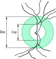 Cup-disc ratio | definition of cup-disc ratio by Medical dictionary