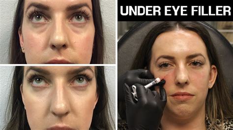 All About Under Eye Filler Restylane & Restylane Lyft Before & After ...