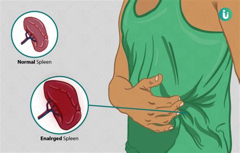 Enlarged Spleen symptoms, causes, treatment, medicine, prevention, diagnosis