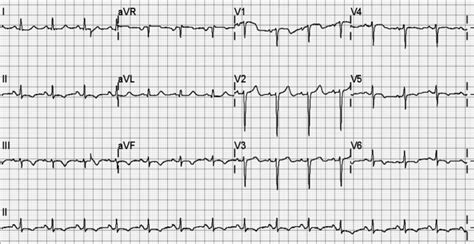 Initial electrocardiogram revealed T wave inversion in leads V 5-6, II ...