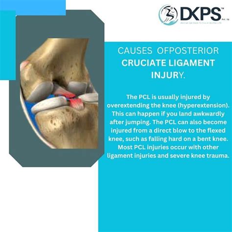 Recover Stronger: PCL Injury Insights & Rehabilitation at DKPS