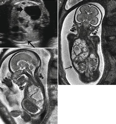 MRI of the Fetal Chest | Radiology Key