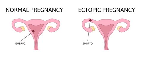 Signs of an Ectopic Pregnancy - This Little Nest