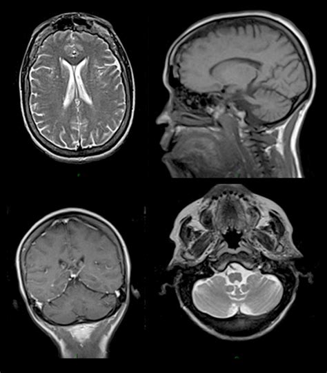 Collection 101+ Pictures Mri Pictures Of Brain Completed 10/2023