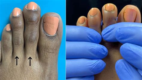 what is toe shortening surgery