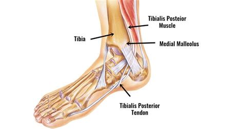 strengthening posterior tibialis > OFF-62%