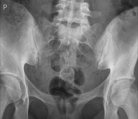 Sacroiliitis grading (New York criteria) | Radiology Reference Article | Radiopaedia.org