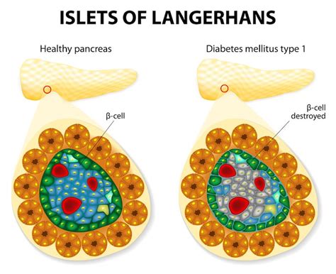 Long-Sought 'Attack' Signal in Type 1 Diabetes Identified | Live Science