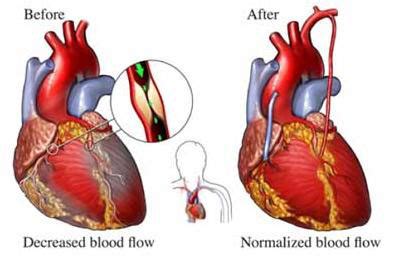 Triple Bypass Surgery Procedure and Possible Risks | New Health Guide