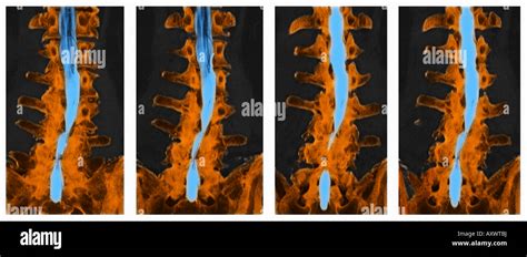 CT Myelogram Lumbar