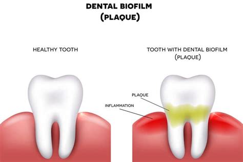 How to Remove Plaque Buildup on Your Teeth