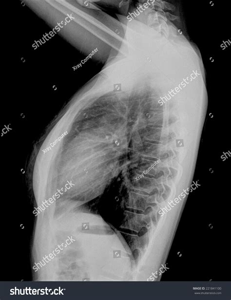 Lateral Chest Xray