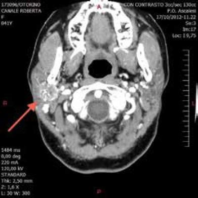 A computed tomography scan shows a non-homogeneously enhancing mass in... | Download Scientific ...