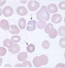 Lead Poisoning - Heme - Medbullets Step 2/3