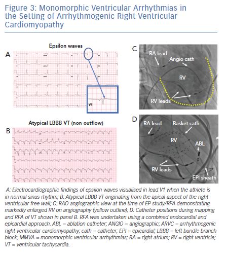 Monomorphic Ventricular Arrhythmias in the Setting of Arrhythmogenic ...