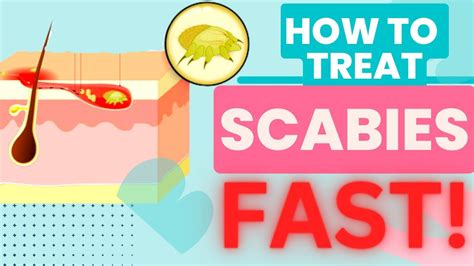 HOW TO TREAT SCABIES FAST! TREATMENT AND HOME REMEDIES - YouTube