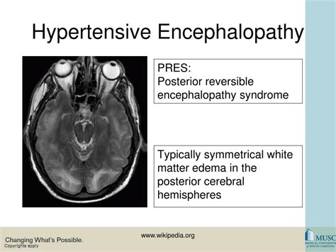 PPT - Hypertensive Emergency PowerPoint Presentation, free download - ID:2945679