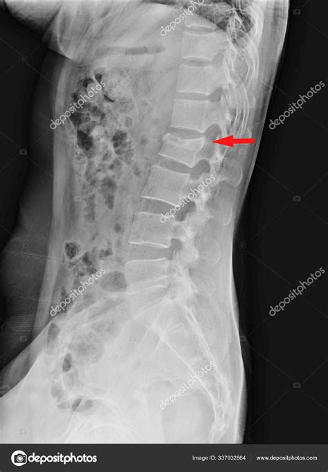 Lumbar spine compression fracture of L2. — Stock Photo © Richmanphoto ...