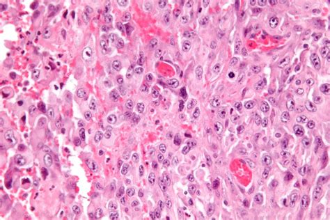 Epithelioid Sarcoma (ES)