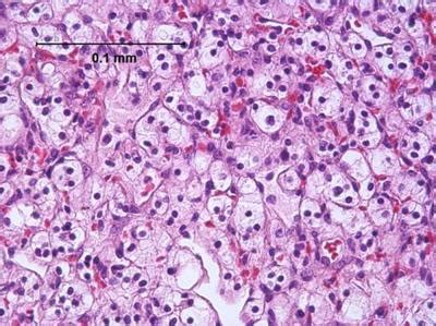 Study reveals connection between kidney cancer and the use of aristolochic acid