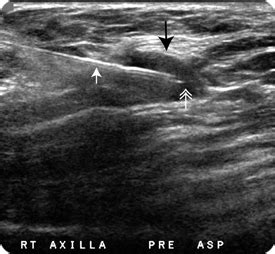 Fine Needle Aspiration | Breast Imaging | VCU Health