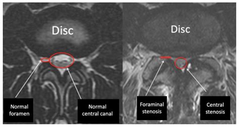 Understanding Your MRI of the Lumbar Spine