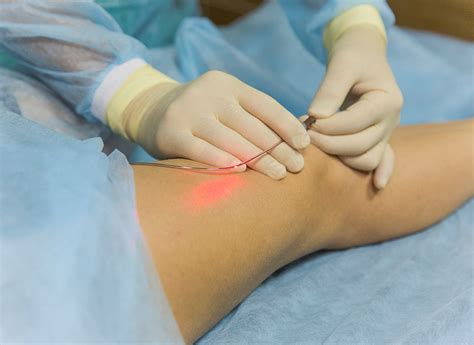 Treatment Laser Acne Veins Removal Soft Heath Therapy Varicose 納得できる割引