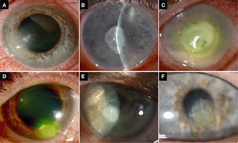 Microbial Keratitis