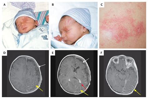 Sturge-Weber Syndrome Sturge-weber Syndrome. Causes, Symptoms ...