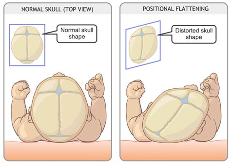 Flattened Head Syndrome or Positional Plagiocephaly