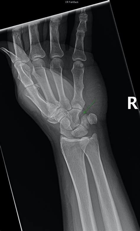 Triquetrum Fracture with Pisiform Dislocation | Published in Orthopedic ...