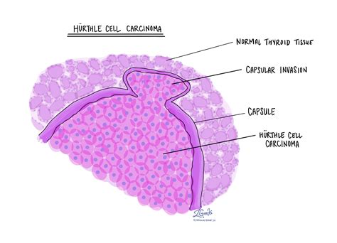 Hurthle cell carcinoma - MyPathologyReport.ca