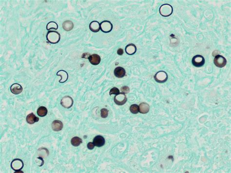 Blastomyces Histology Slides