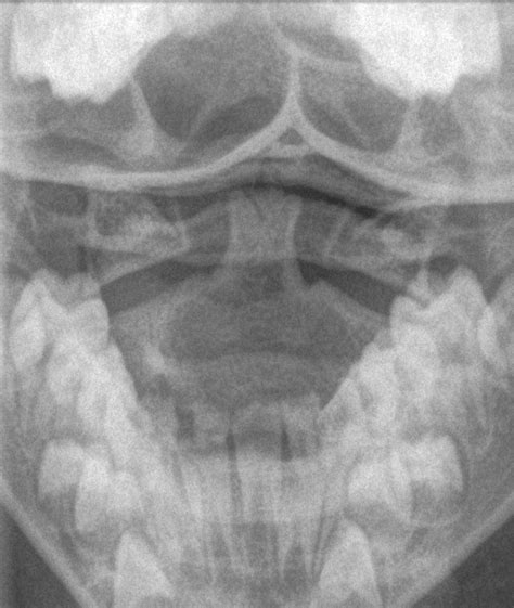 Cervical pseudosubluxation | Image | Radiopaedia.org