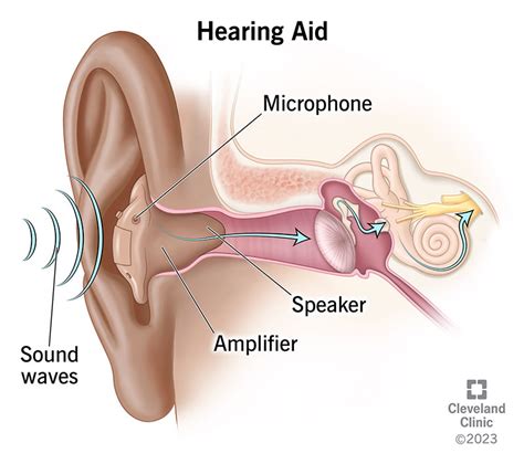 Hearing Aids: Uses & How They Work