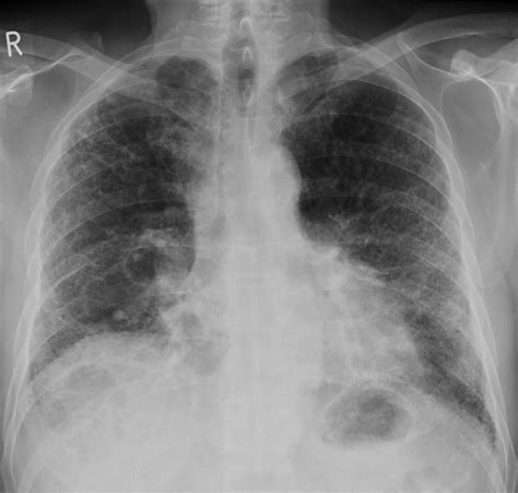 Pulmonary fibrosis - Radiology at St. Vincent's University Hospital