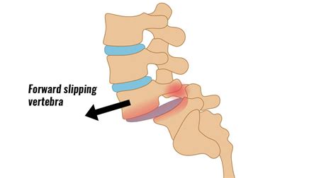 Spondylolisthesis - Symptoms, Causes, Treatment and Rehabilitation