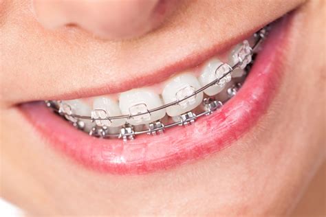 Make the Most of Your Mouth with Adult Braces