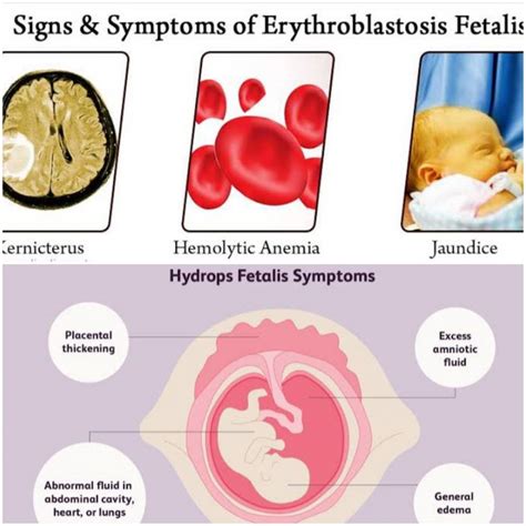 All about Hydrops Fetalis & Erythroblastosis Fetalis – Platform | CME