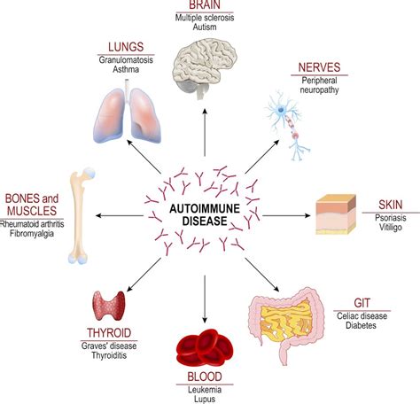 An autoimmune-like antibody response is linked with severe Covid-19 ...